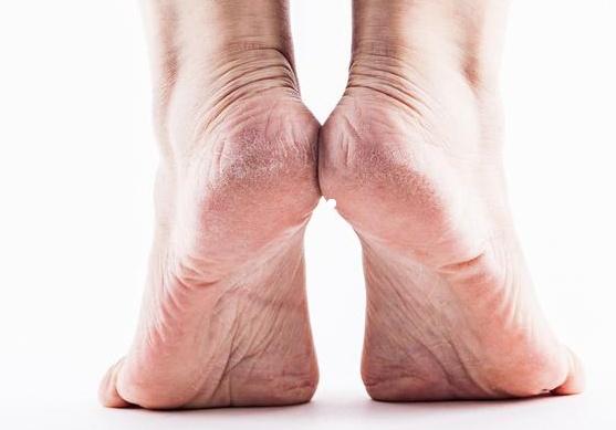 腳后跟經(jīng)常起皮開裂，是缺乏維生素嗎